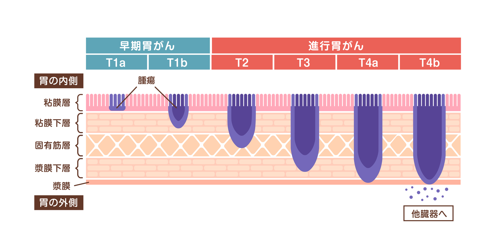 胃がんとは